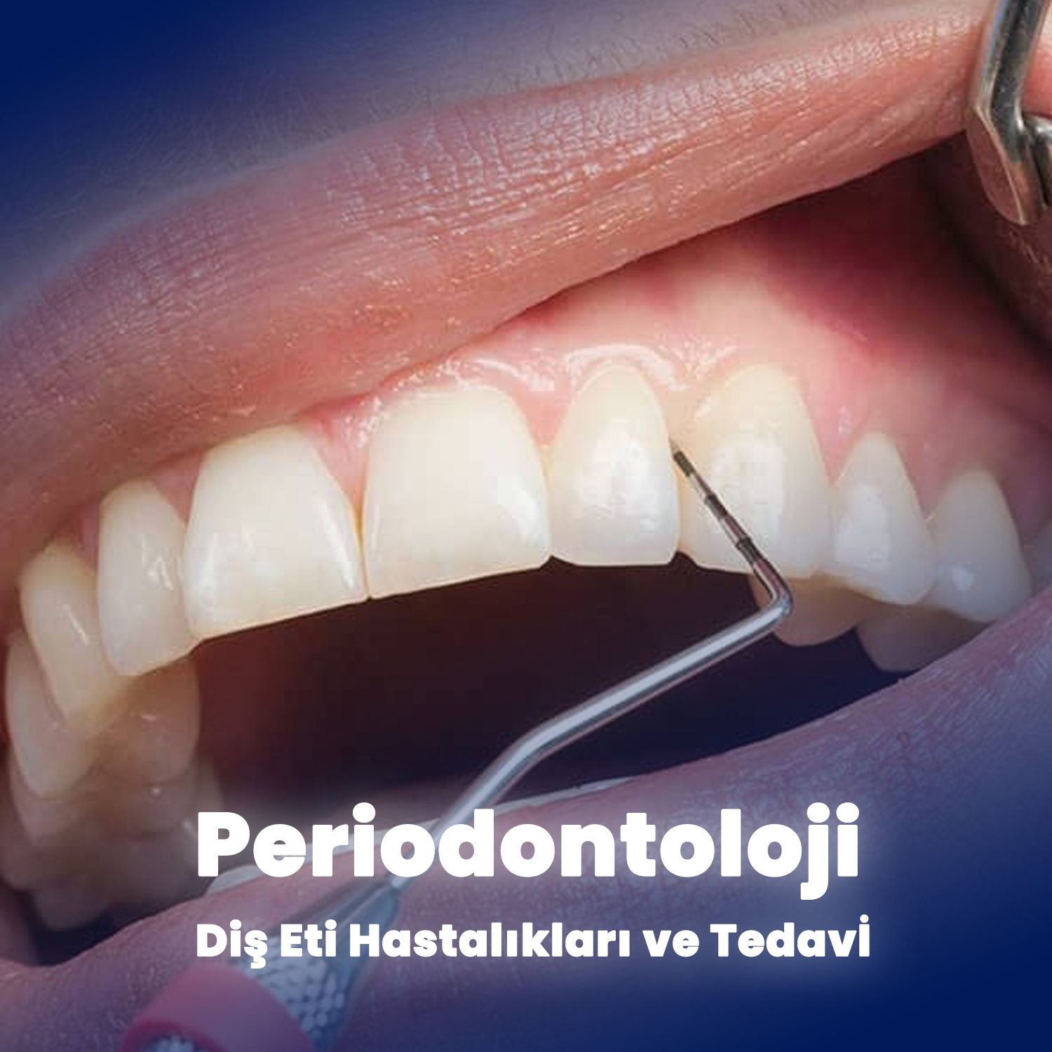 Periodontoloji: Diş Eti Hastalıkları ve Tedavİ